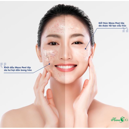 PEEL MESO HÀN QUỐC